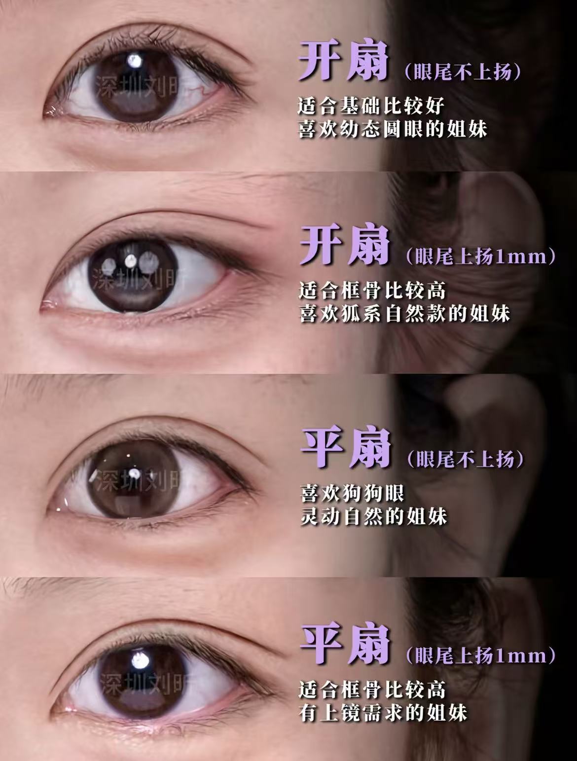 双眼皮手术