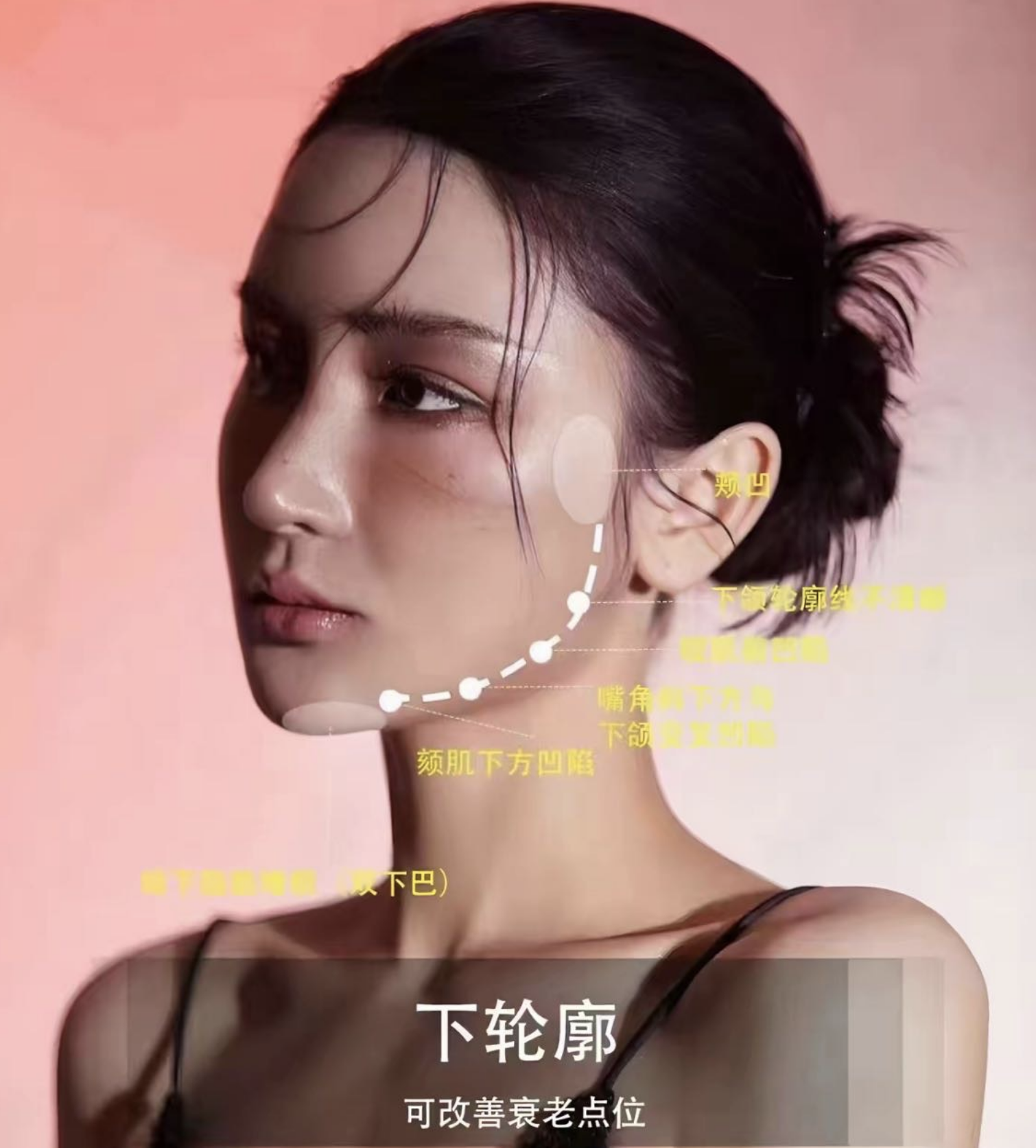 玻尿酸填充