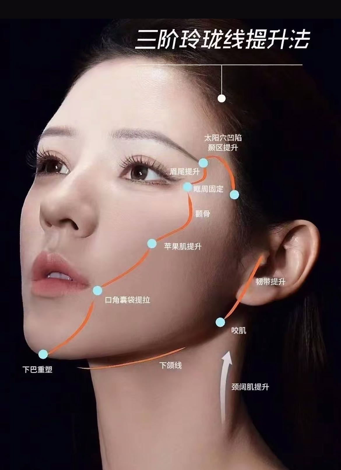 线雕提升